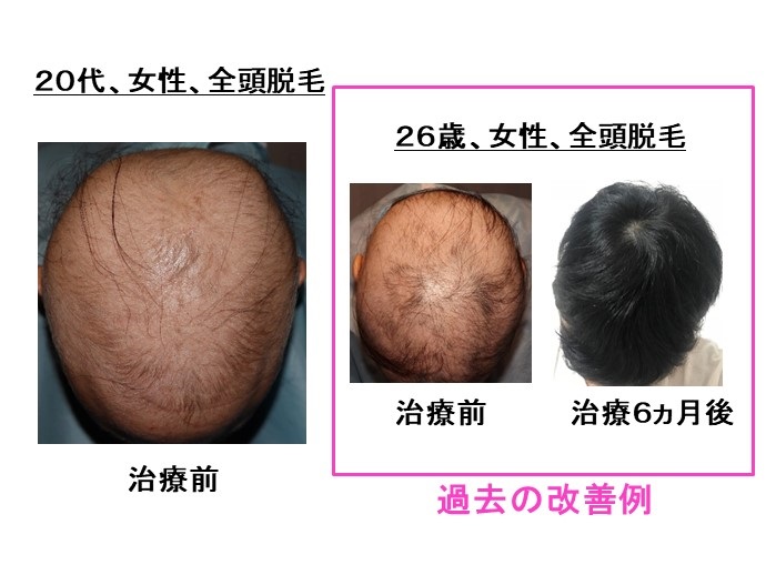 円形脱毛症　病院